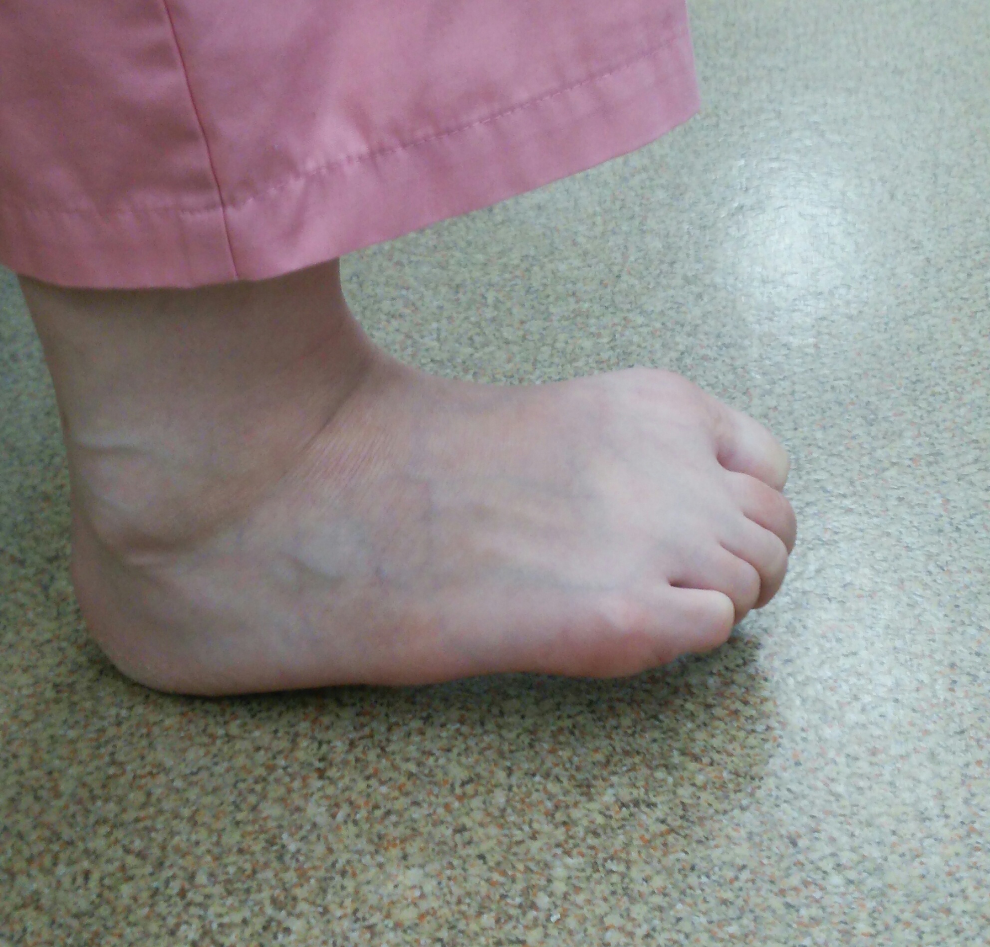 踵の痛み 足底筋膜炎 踵骨棘 さつきが丘接骨院
