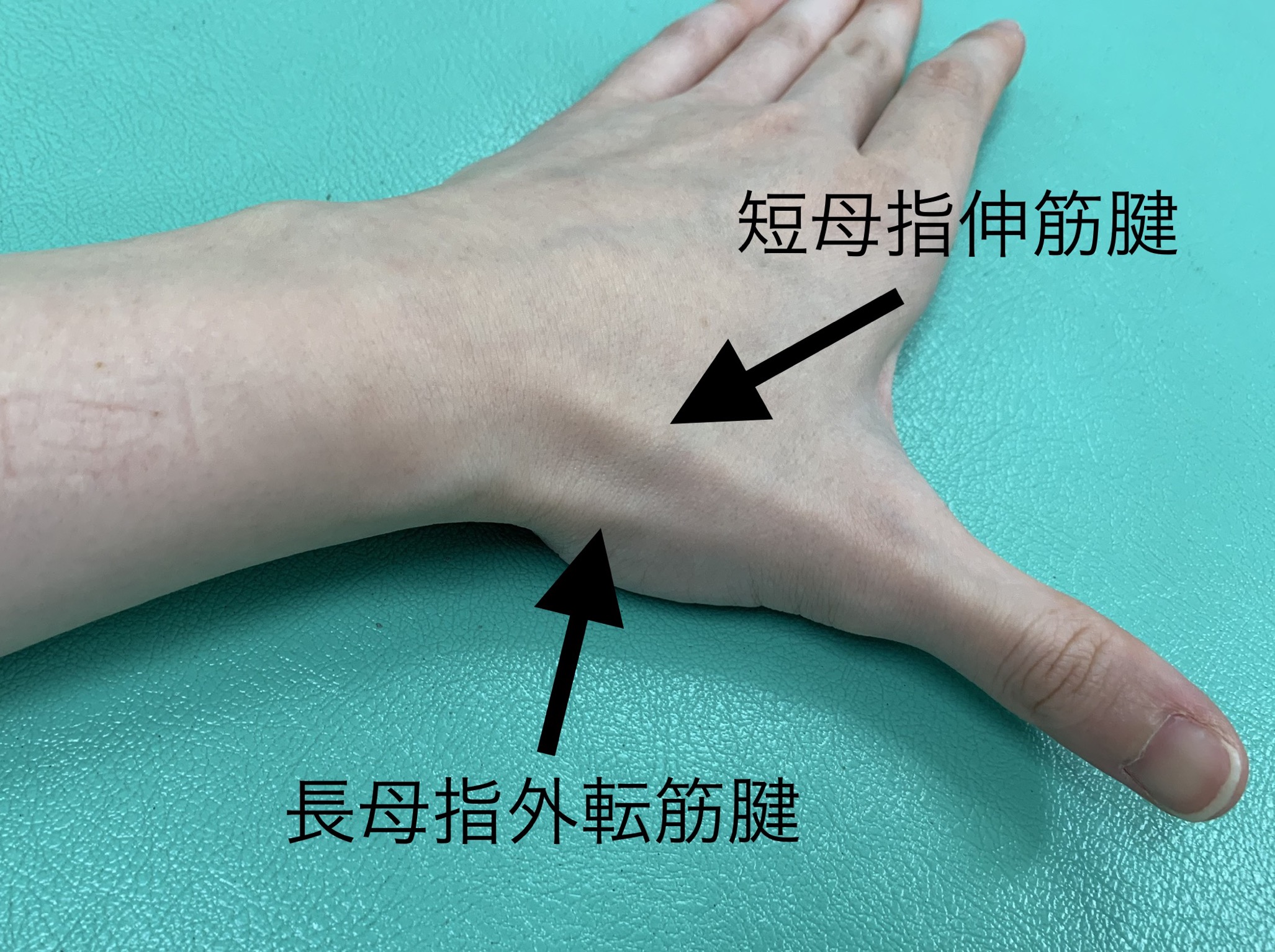 ドケルバン病 親指の狭窄性腱鞘炎 さつきが丘接骨院